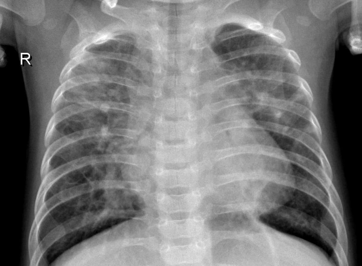 Pneumonia — NIH Chest X-ray14