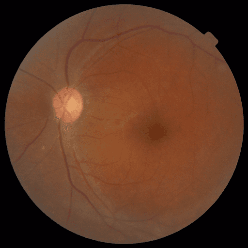 Proliferative DR — MESSIDOR-2