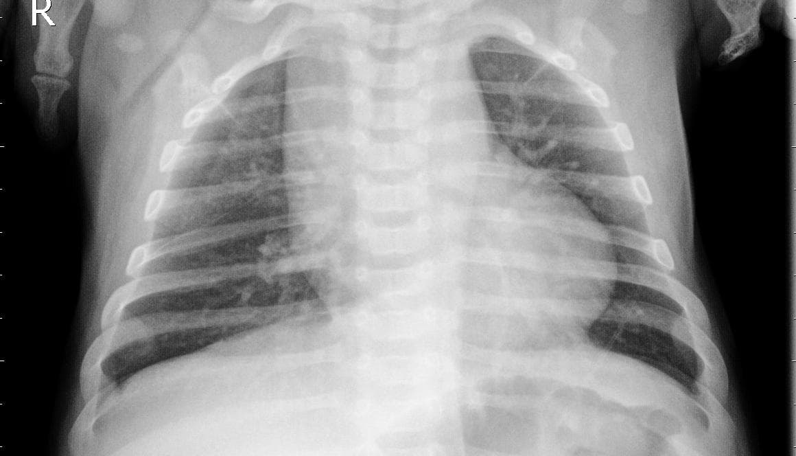 Pneumonia — NIH Chest X-ray14