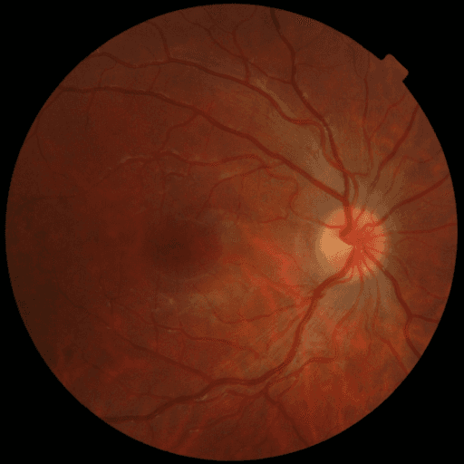 No Diabetic Retinopathy — MESSIDOR-2