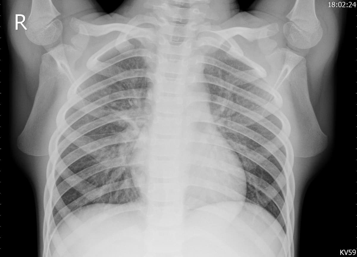 Pneumonia — NIH Chest X-ray14
