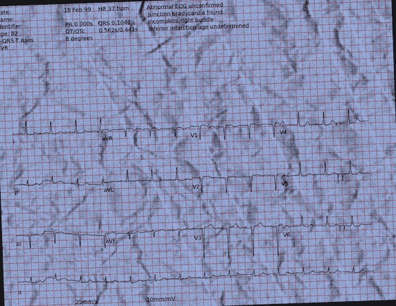 Normal ECG — PTB-XL