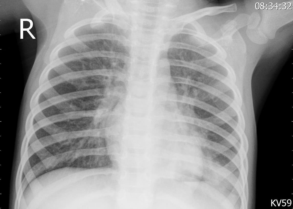 Pneumonia — NIH Chest X-ray14