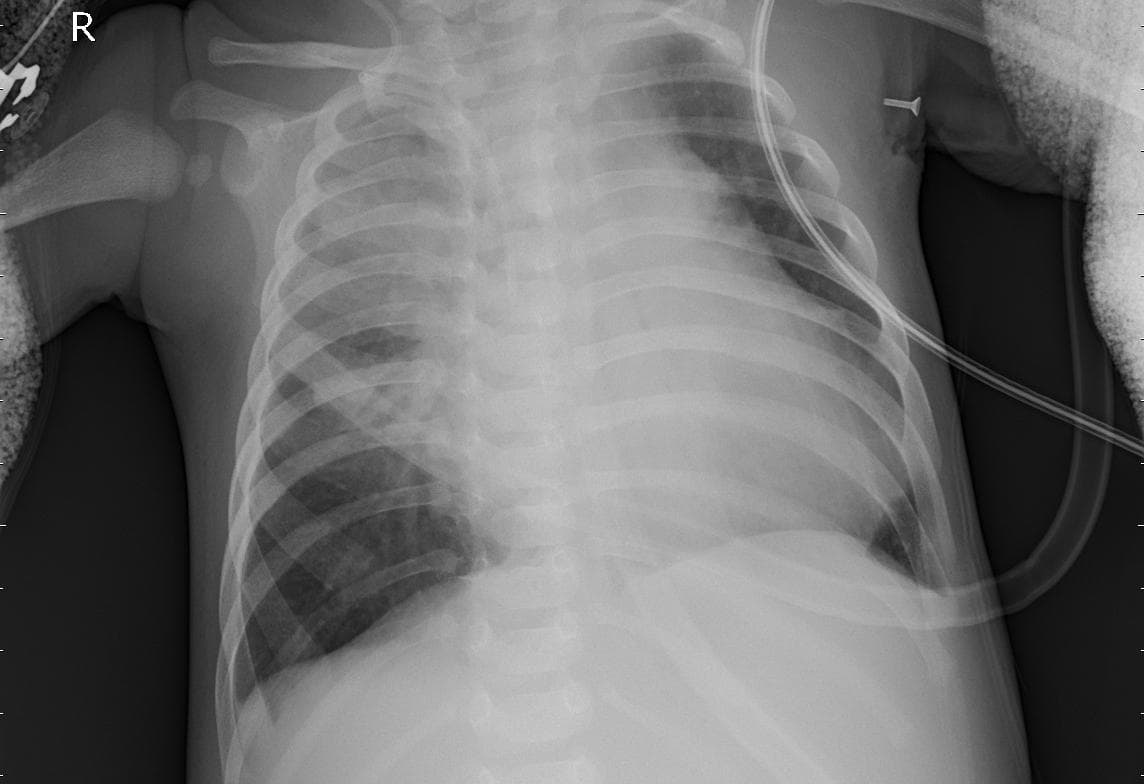 Pneumonia — NIH Chest X-ray14