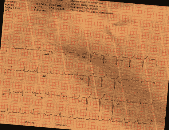 Normal ECG — PTB-XL