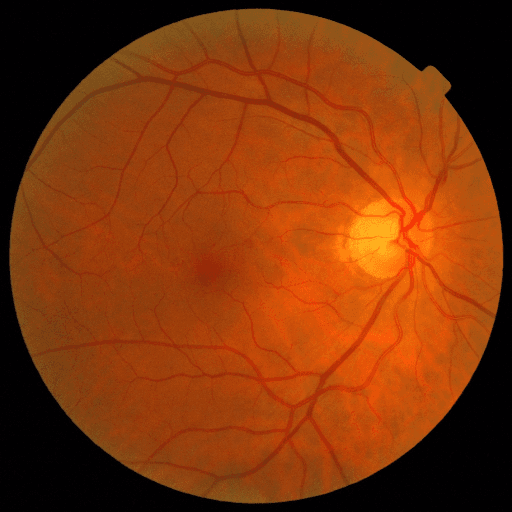 No Diabetic Retinopathy — MESSIDOR-2
