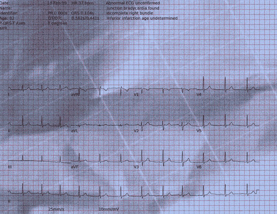 Normal ECG — PTB-XL