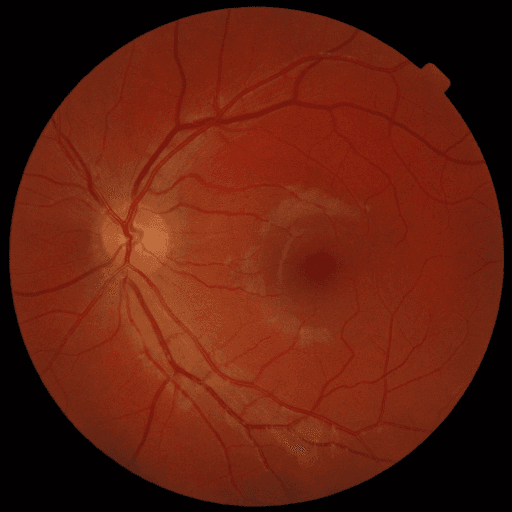 No Diabetic Retinopathy — MESSIDOR-2