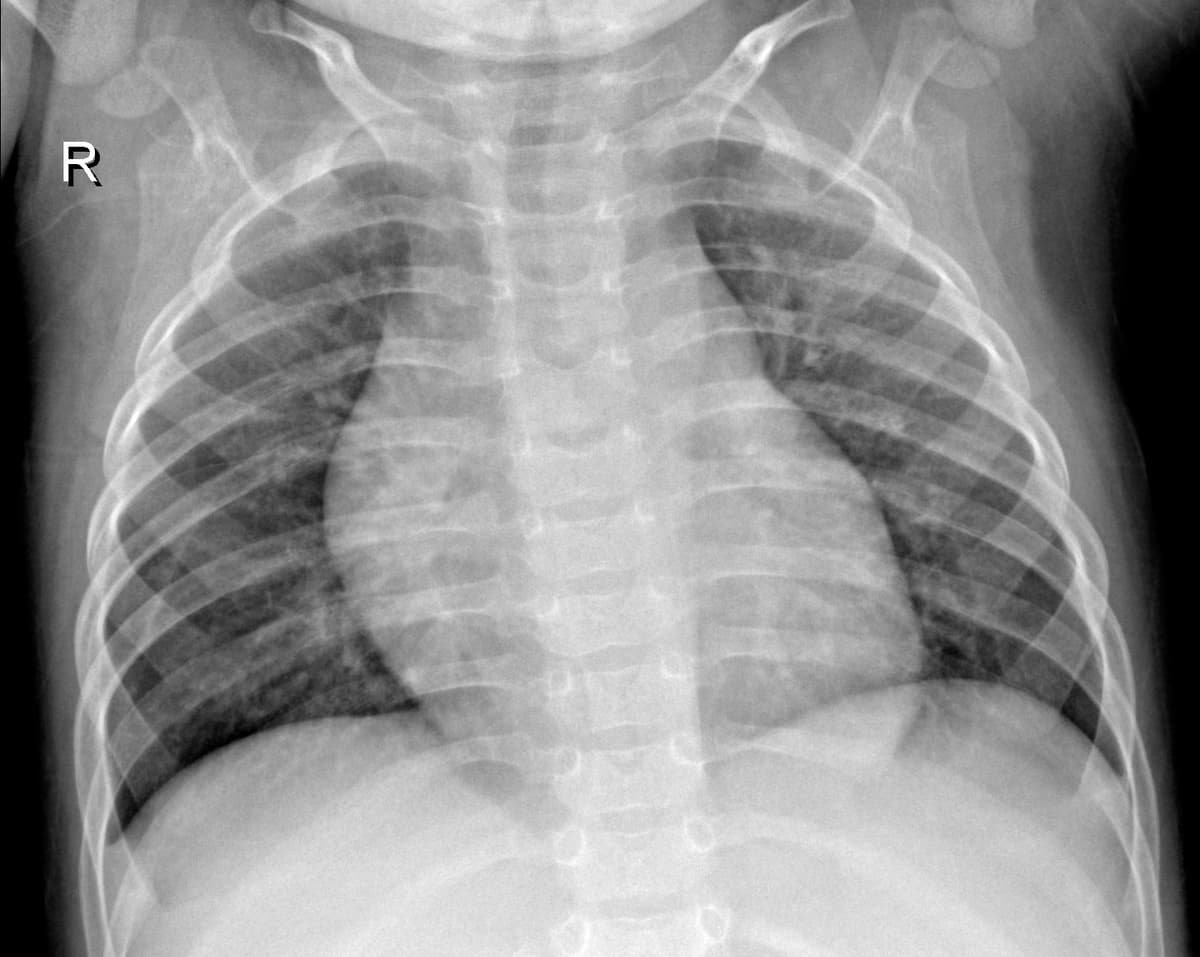 Radiografia Normal — NIH Chest X-ray14