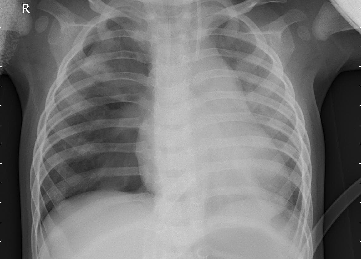 Pneumonia — NIH Chest X-ray14