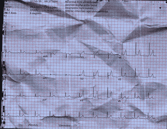 Normal ECG — PTB-XL
