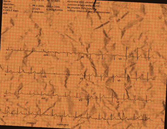 Normal ECG — PTB-XL