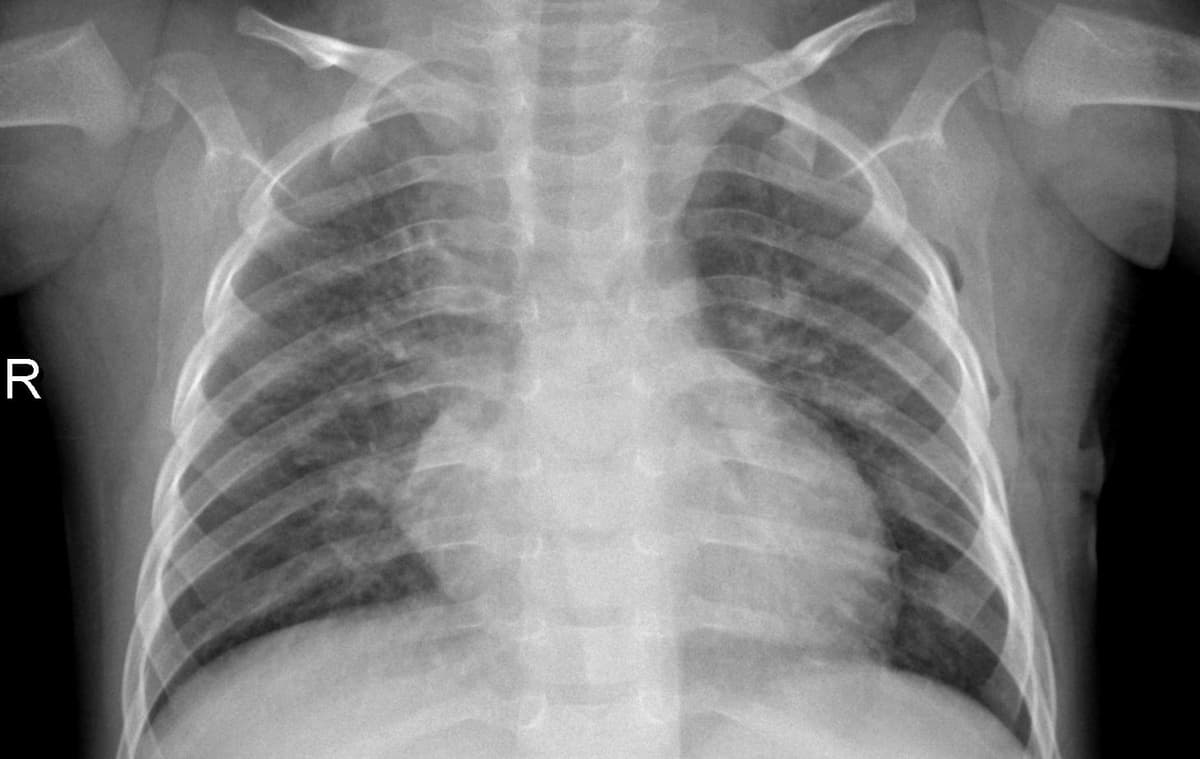 Pneumonia — NIH Chest X-ray14