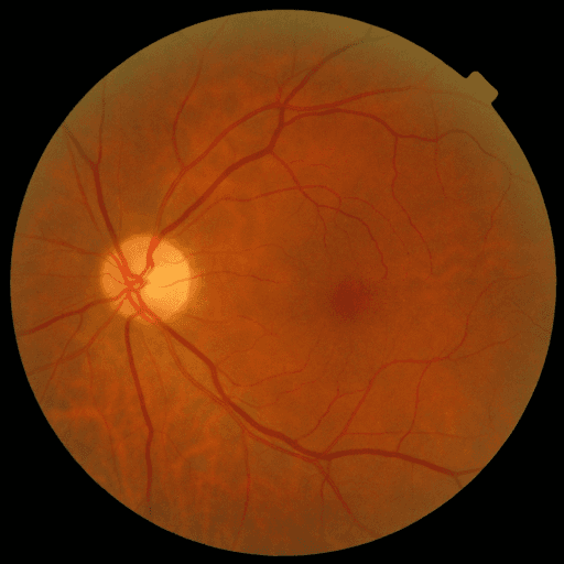 No Diabetic Retinopathy — MESSIDOR-2