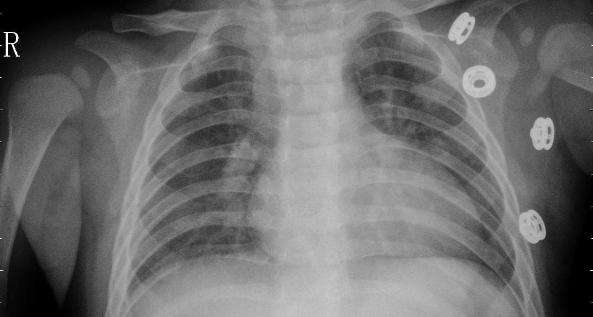 Pneumonia — NIH Chest X-ray14