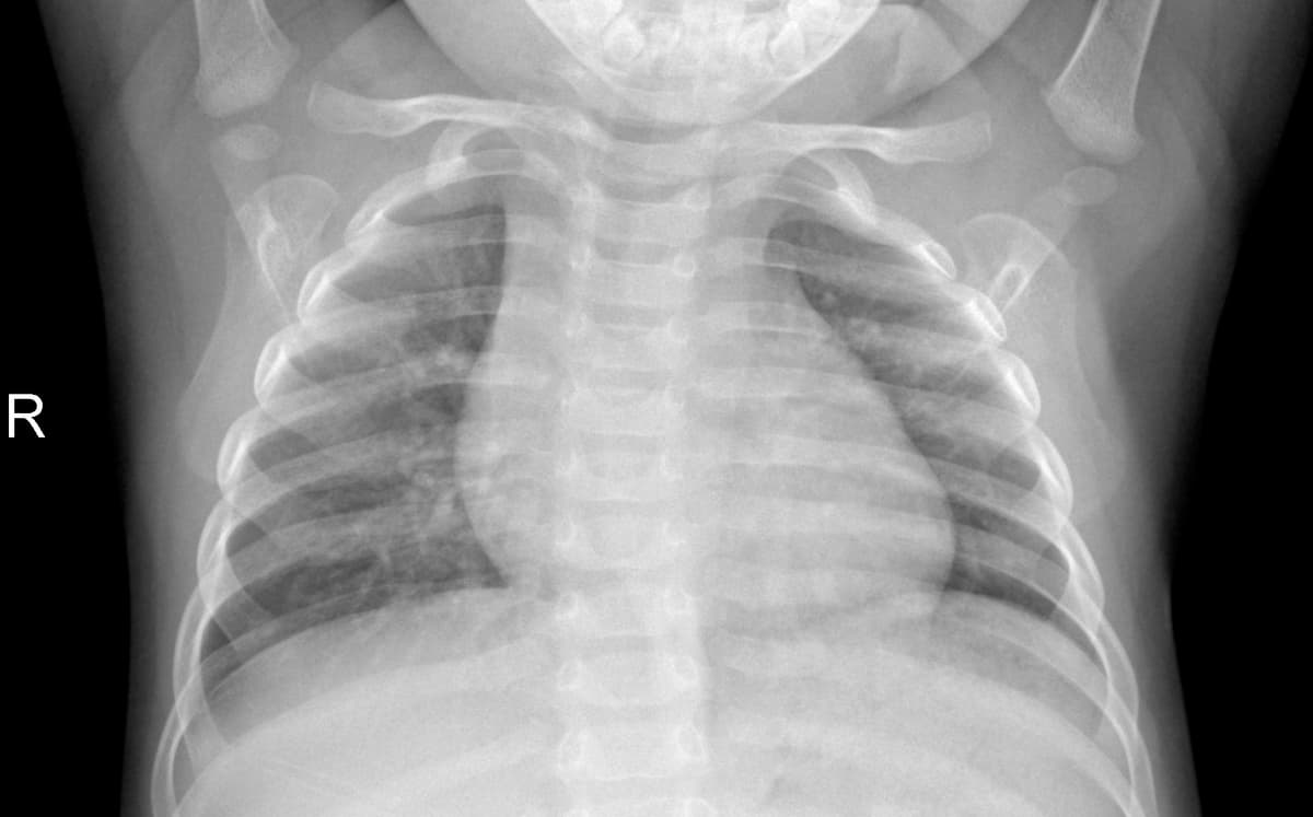 Radiografia Normal — NIH Chest X-ray14
