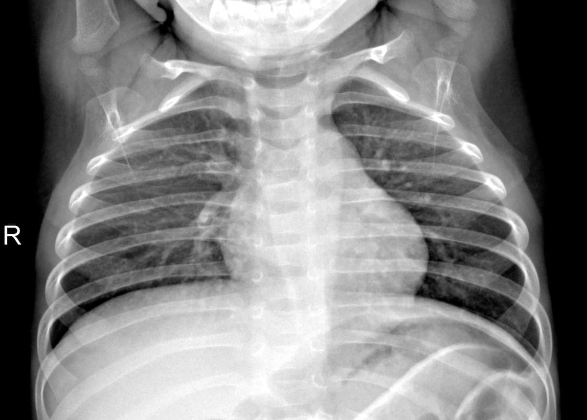Radiografia Normal — NIH Chest X-ray14
