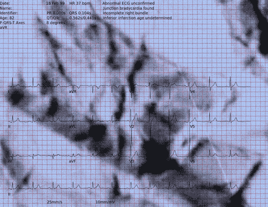 Normal ECG — PTB-XL