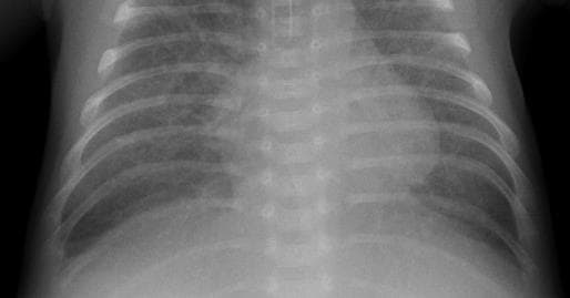 Pneumonia — NIH Chest X-ray14