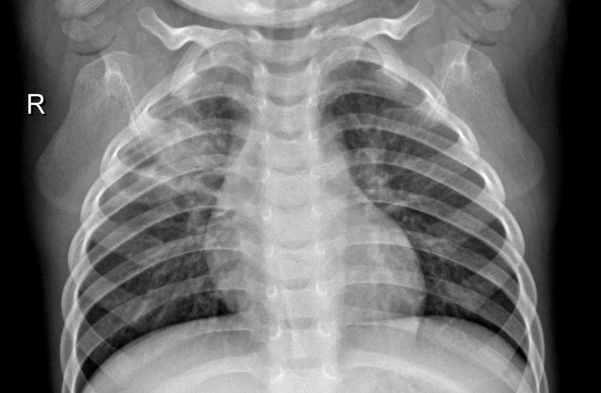 Pneumonia — NIH Chest X-ray14