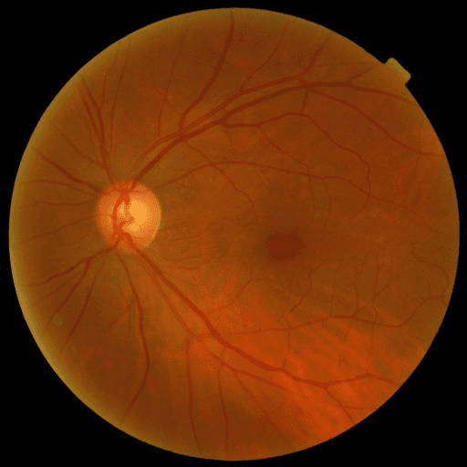 No Diabetic Retinopathy — MESSIDOR-2
