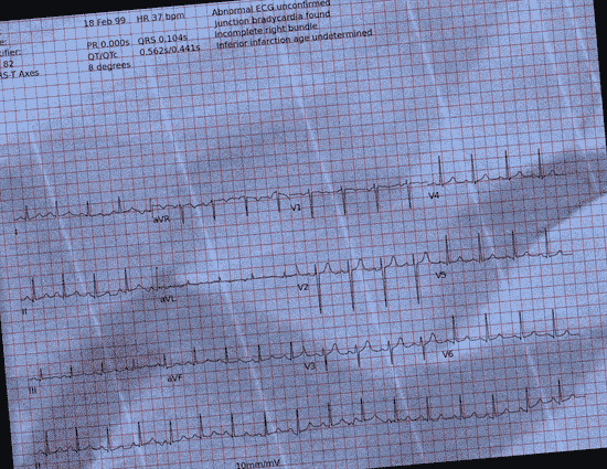 Normal ECG — PTB-XL