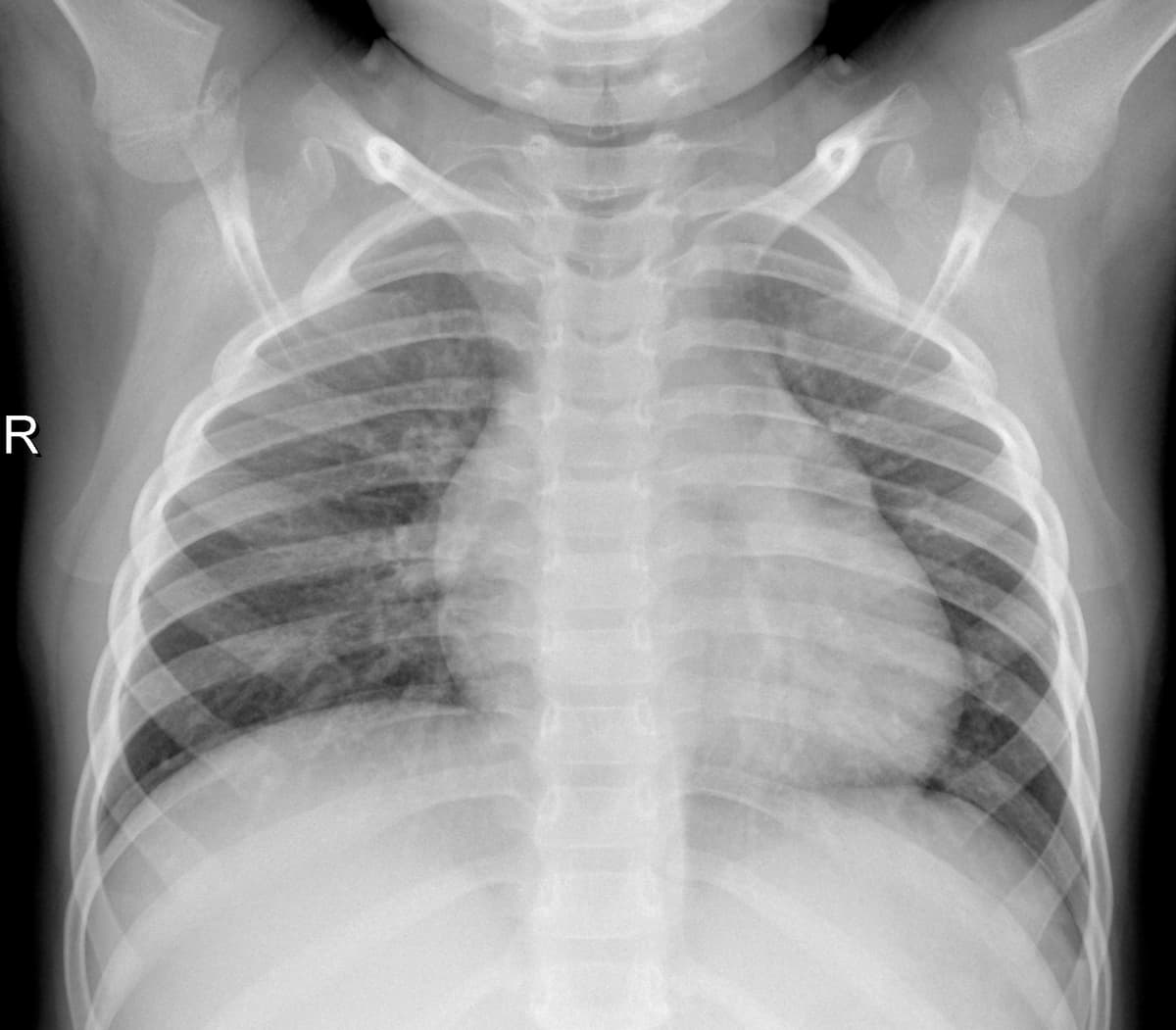 Radiografia Normal — NIH Chest X-ray14