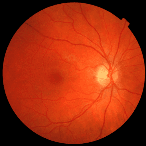 No Diabetic Retinopathy — MESSIDOR-2