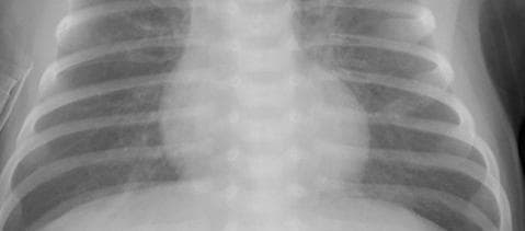 Pneumonia — NIH Chest X-ray14