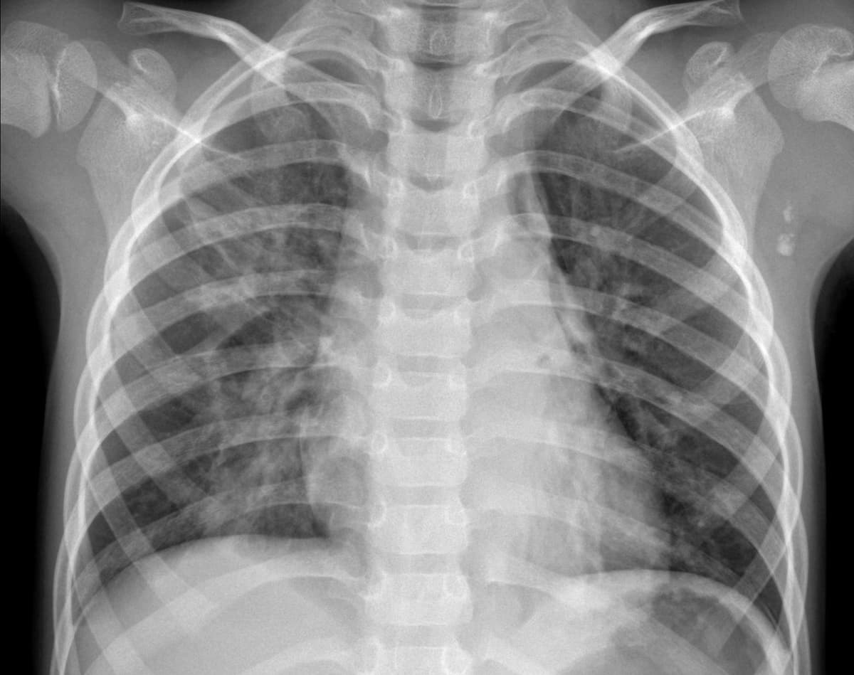 Pneumonia — NIH Chest X-ray14
