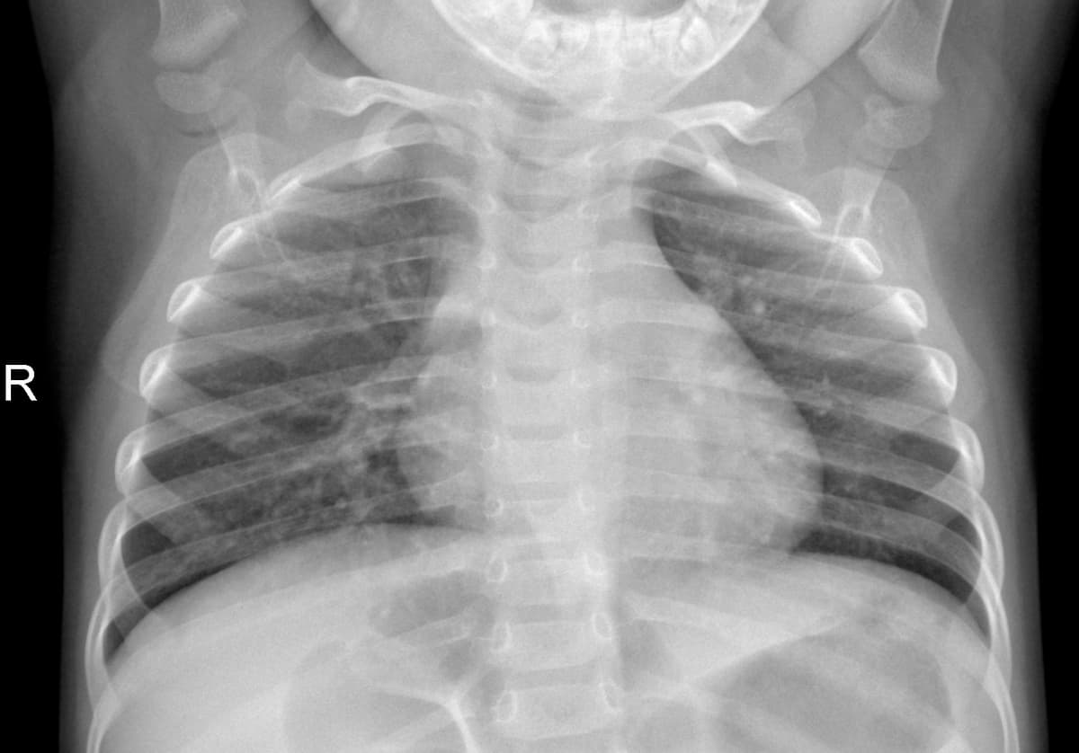 Radiografia Normal — NIH Chest X-ray14