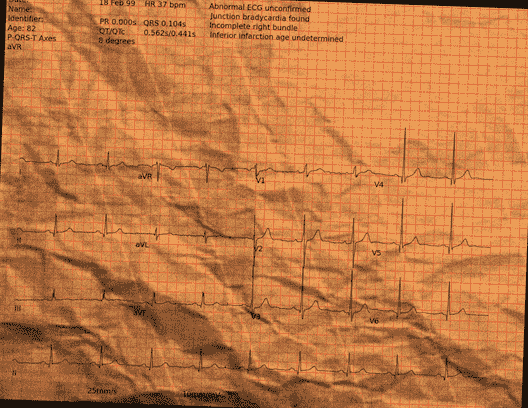 Normal ECG — PTB-XL