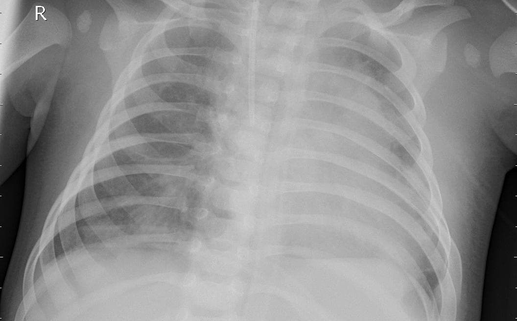 Pneumonia — NIH Chest X-ray14