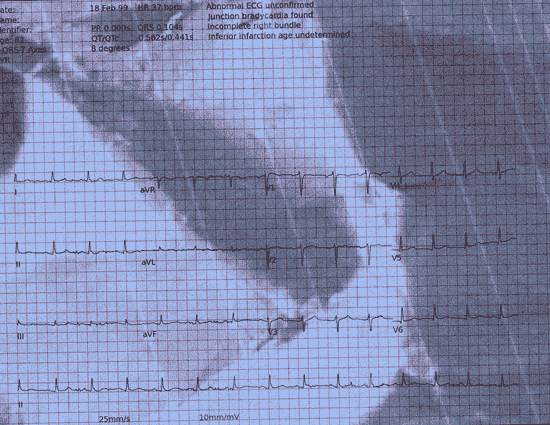 Normal ECG — PTB-XL