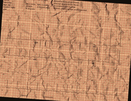 Normal ECG — PTB-XL
