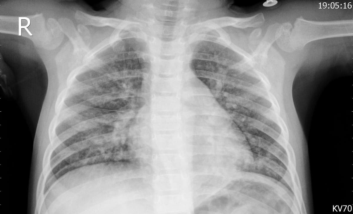 Pneumonia — NIH Chest X-ray14