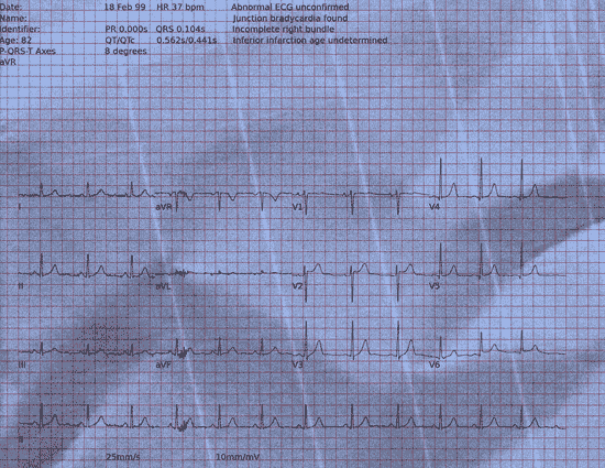 Normal ECG — PTB-XL