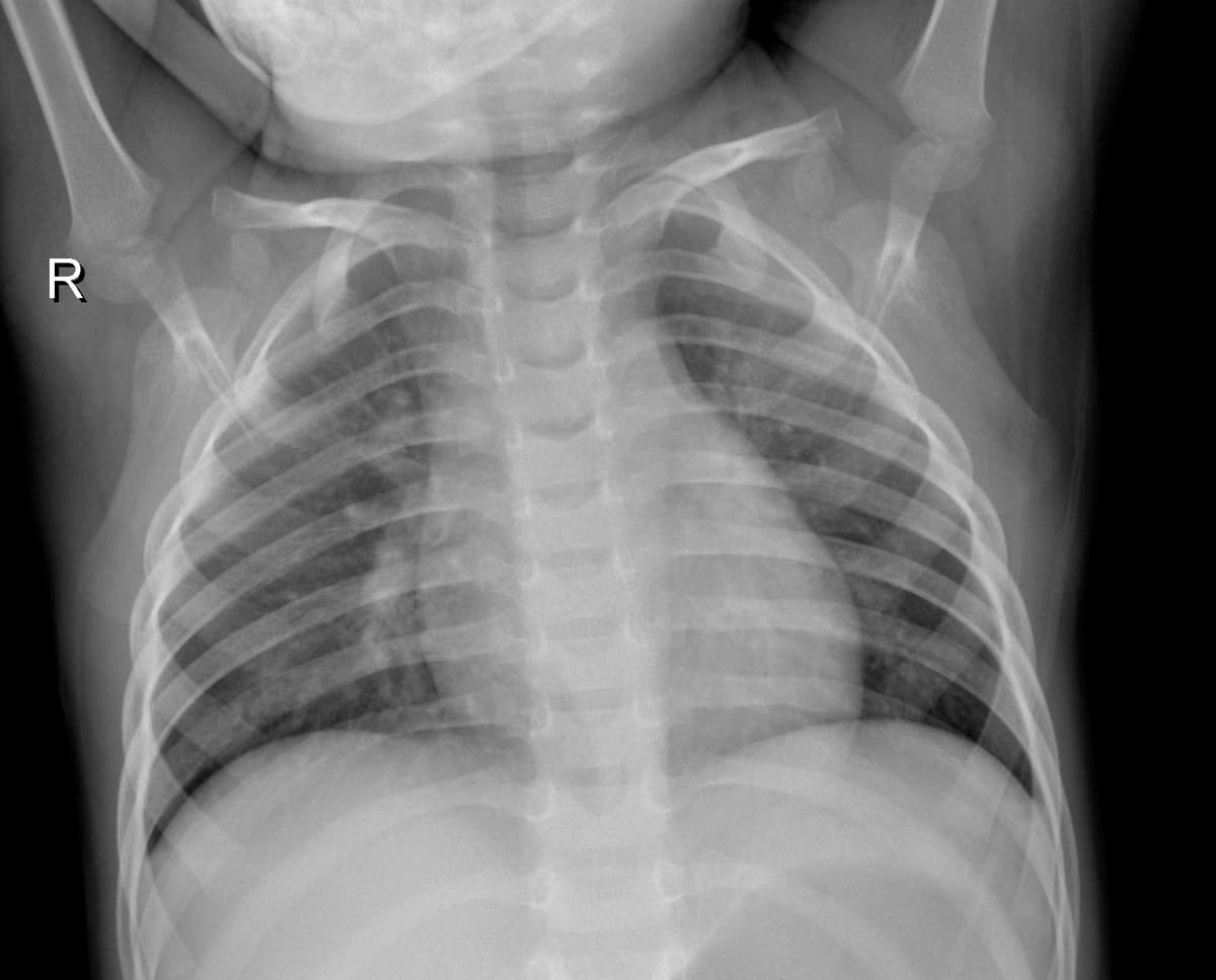 Radiografia Normal — NIH Chest X-ray14