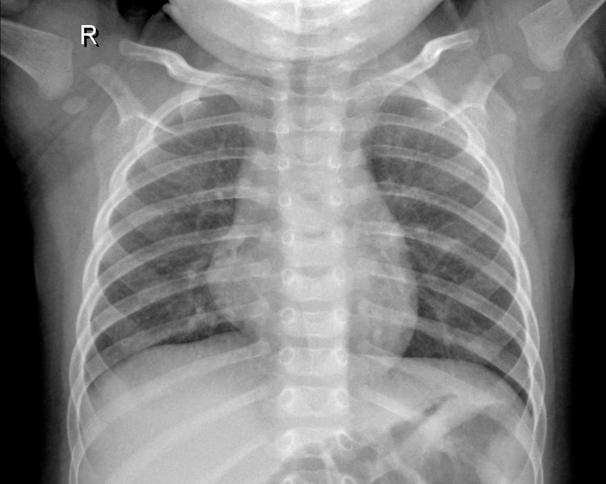 Radiografia Normal — NIH Chest X-ray14