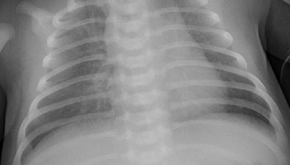 Pneumonia — NIH Chest X-ray14