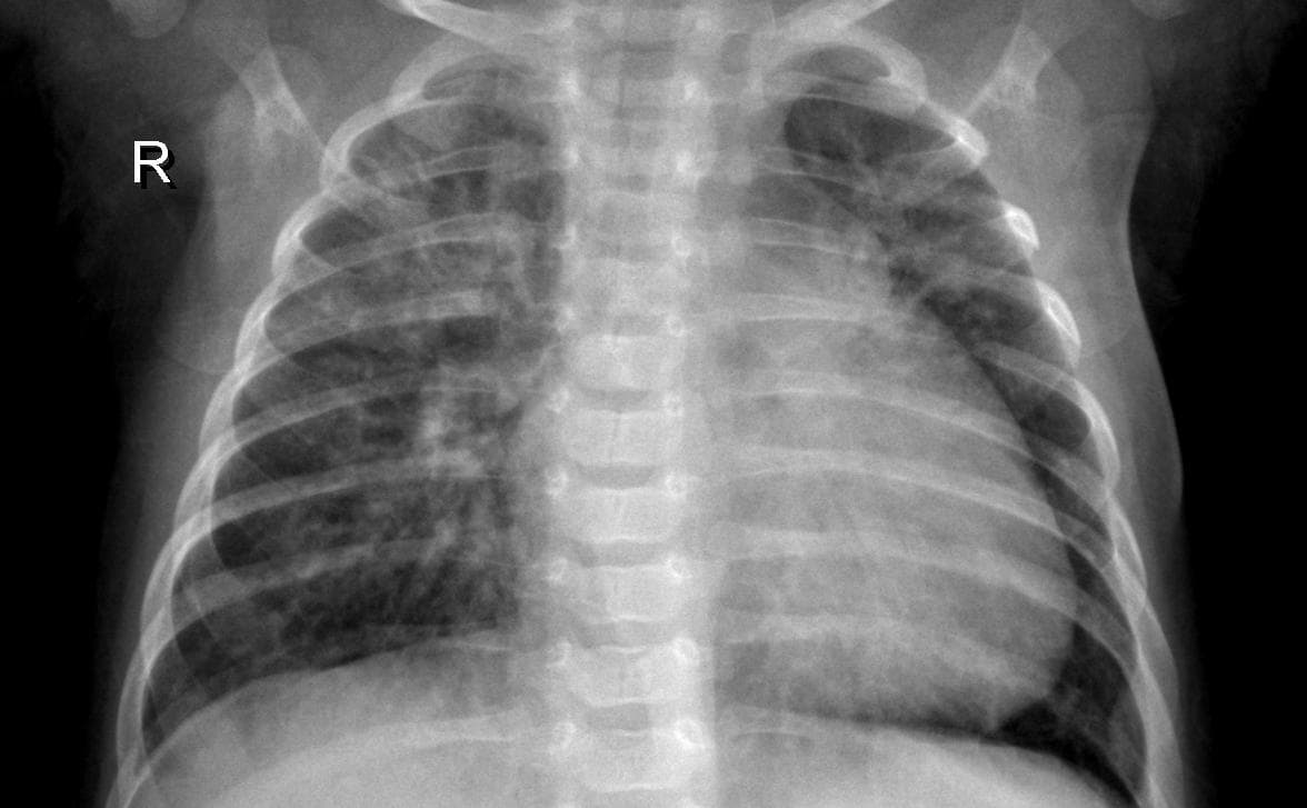 Pneumonia — NIH Chest X-ray14
