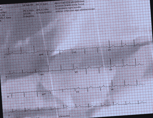 Normal ECG — PTB-XL