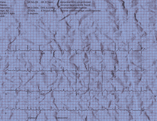 Normal ECG — PTB-XL