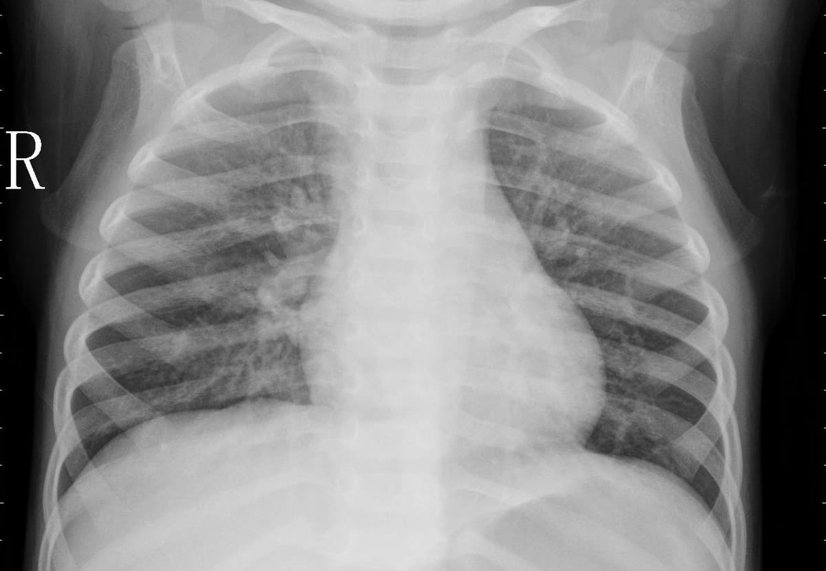 Pneumonia — NIH Chest X-ray14