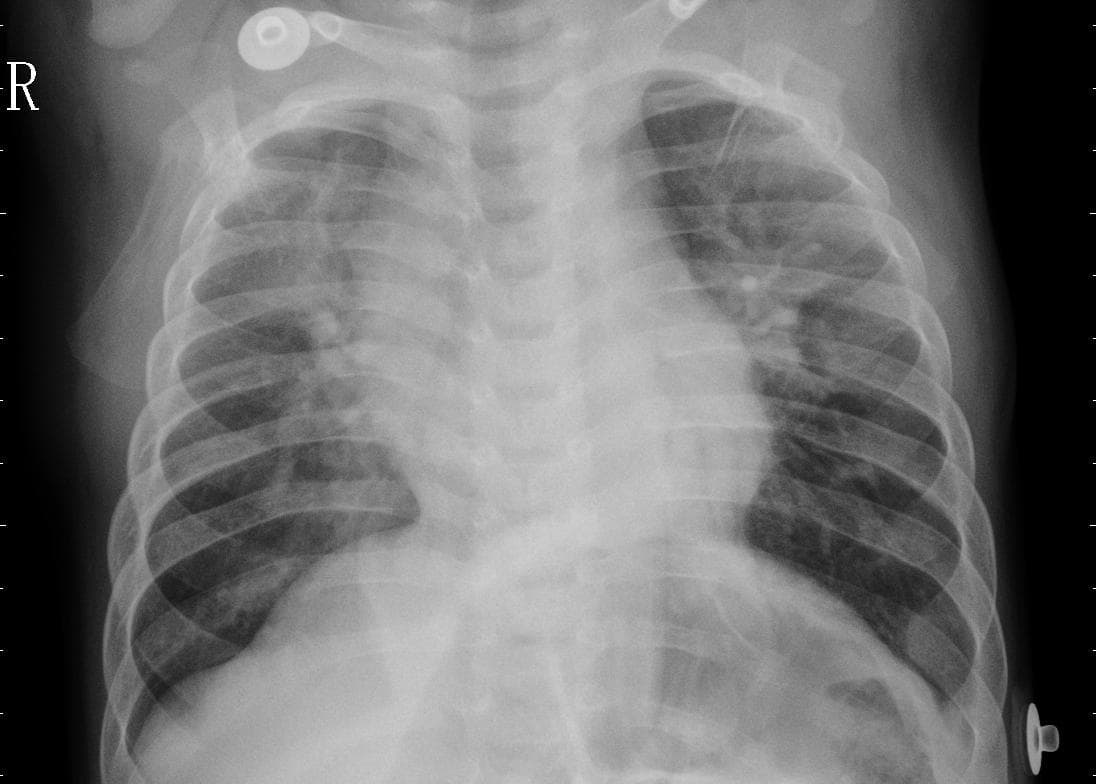 Pneumonia — NIH Chest X-ray14