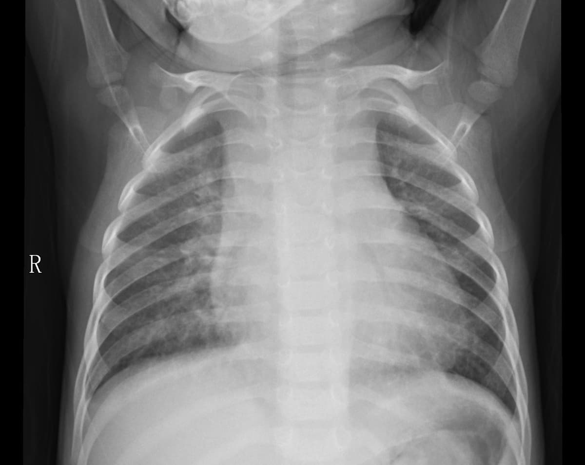 Pneumonia — NIH Chest X-ray14