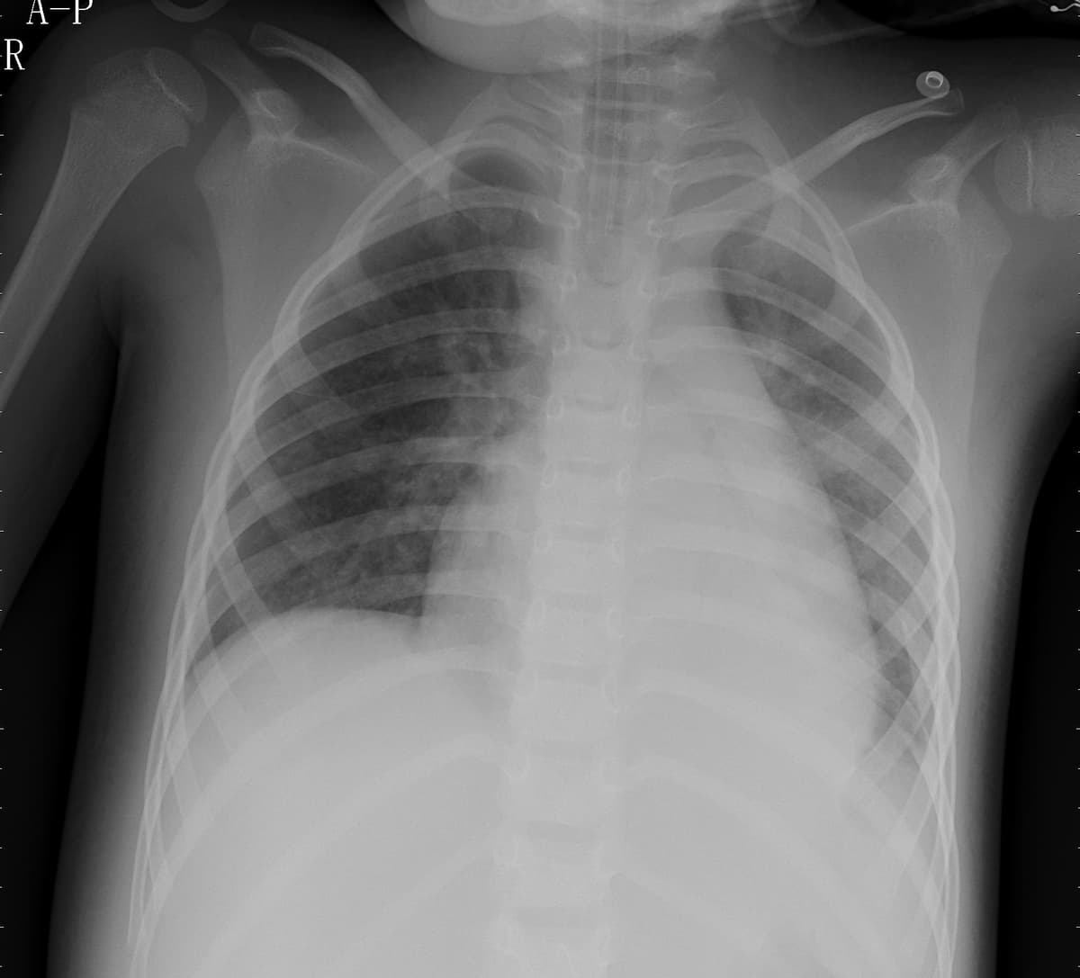 Pneumonia — NIH Chest X-ray14