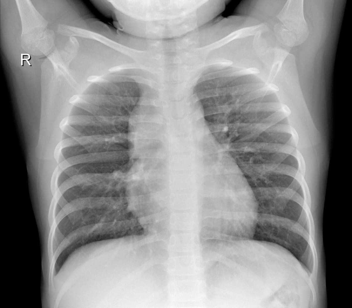 Radiografia Normal — NIH Chest X-ray14