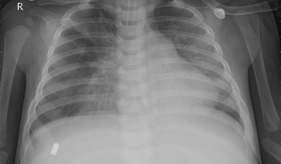 Pneumonia — NIH Chest X-ray14