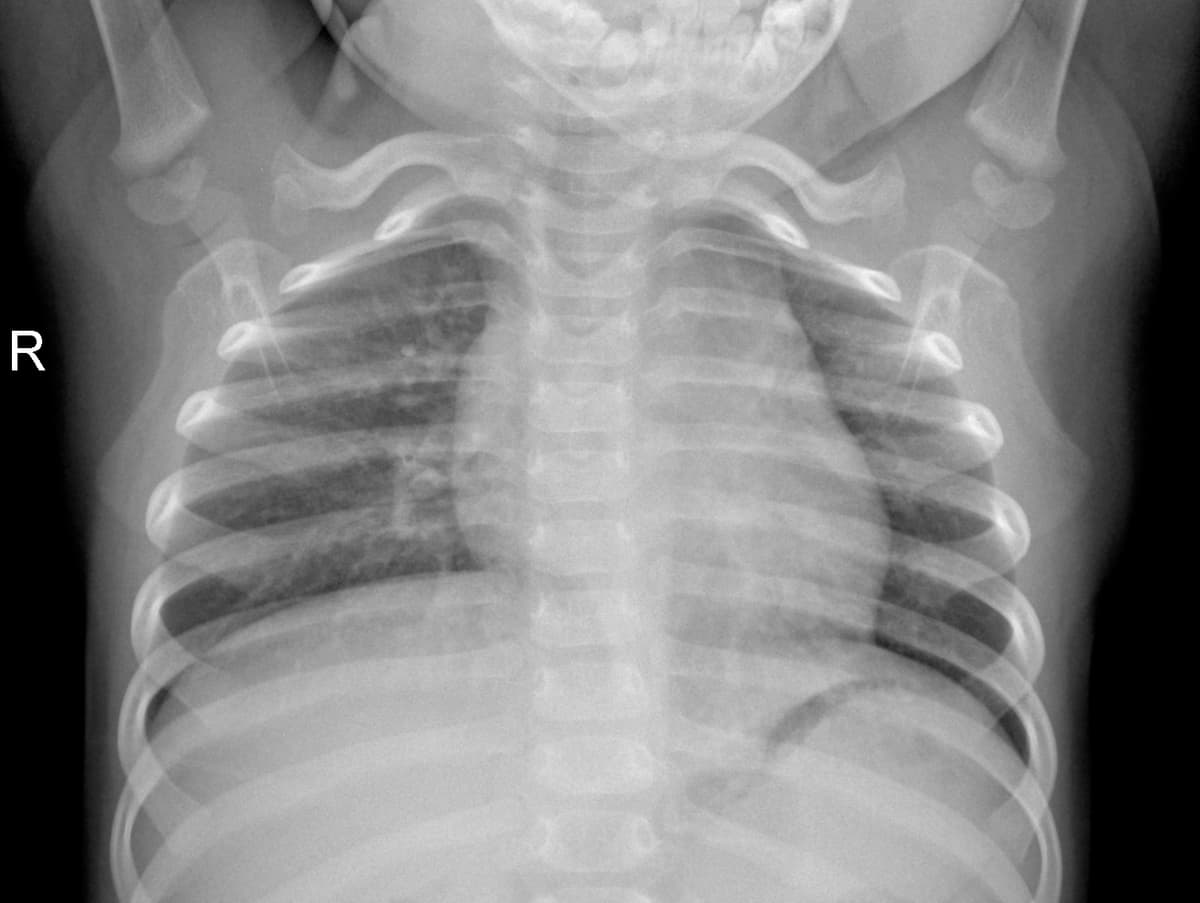 Radiografia Normal — NIH Chest X-ray14